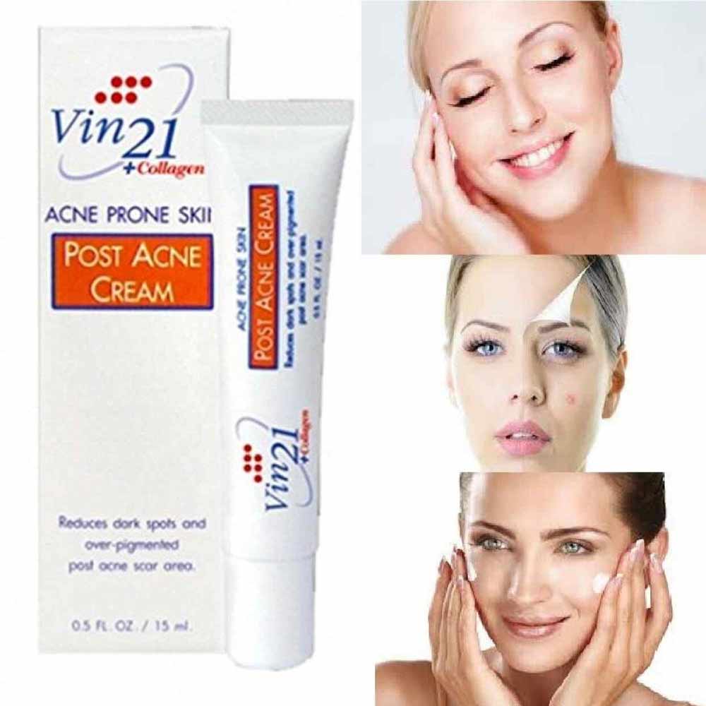 Vin21 Anti Acne Cream